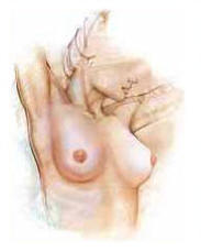 Modesto Breast Augmentation drawing Breast Augmentation Modesto